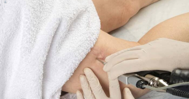 Innovadora cirugía láser de várices pélvicas promete tratamiento seguro y accesible