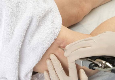 Innovadora cirugía láser de várices pélvicas promete tratamiento seguro y accesible